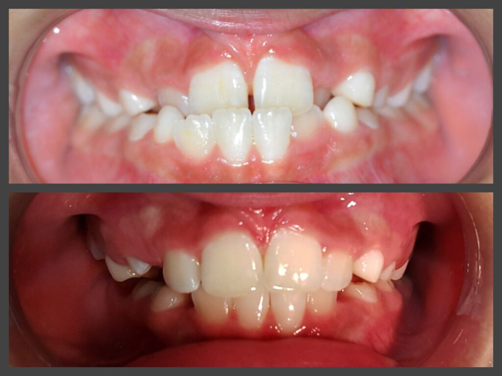 Ortodontia - Zeponi Mello